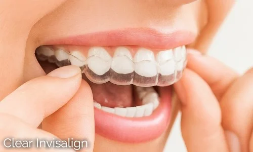Invisalign Clear Aligners Invisalign Clear Aligners