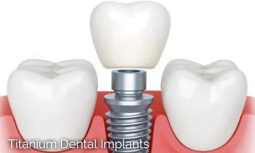 Dental Implant Crowns and Bridges